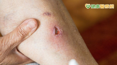 他傷口一直好不了險遭截肢！「1治療方式」解除危機